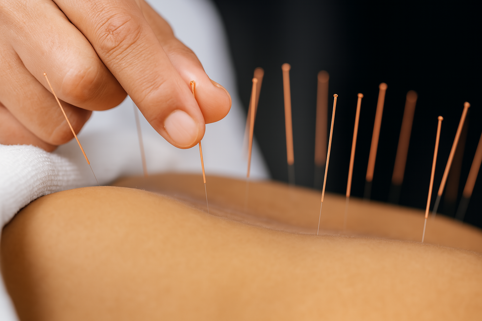 Akupunktur